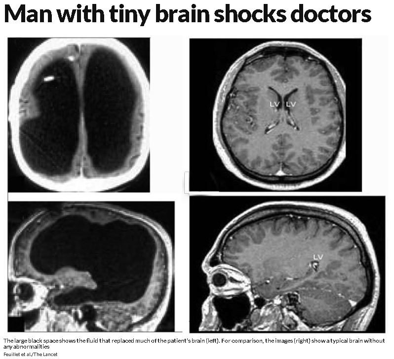 Quelle: New Scientist (2007, July 20): Man with tiny brain shocks doctors. Web, abgerufen von www.newscientist.com/article/dn12301-man-with-tiny-brain-shocks-doctors/